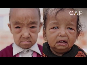 Meet the 'Benjamin Button' children who look like pensioners