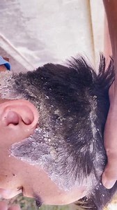 4.4K views · 18 reactions | Ultra Thick Flake Shell Removal Session #3559 #ticks #Dandruff #dandrufftreatment #fblifestyle #fypシ | Hair ticks | Facebook