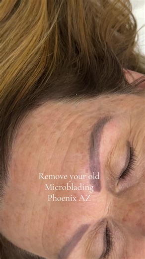 Brow tattoo removal 602-400-7650 #az #phoenixaz #browtattooremoval