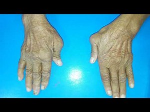 Rheumatoid Arthritis Hand Deformities