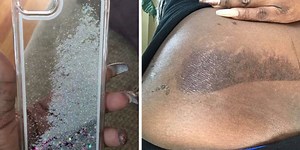 People Are Getting Horrible Burns From the Liquid in Their Glitter Phone Cases
