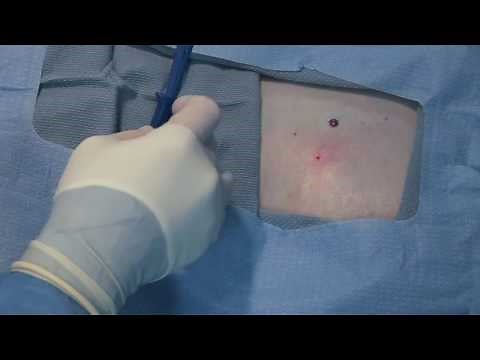 Medtronic Reveal Linq Implant - Infra-mammary approach