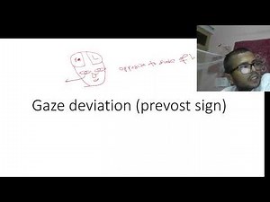 prevost sign (gaze deviation in a patient with stroke)