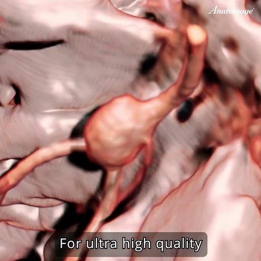 CT vs Anatomage: Basilar Artery Aneurysm