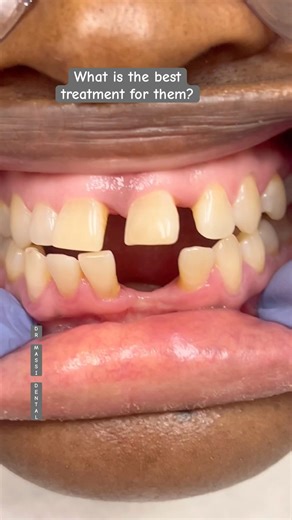BIG GAPS BETWEEN TEETH