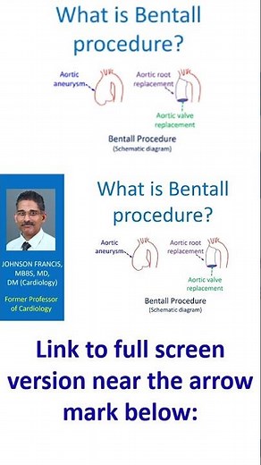 What is Bentall procedure?