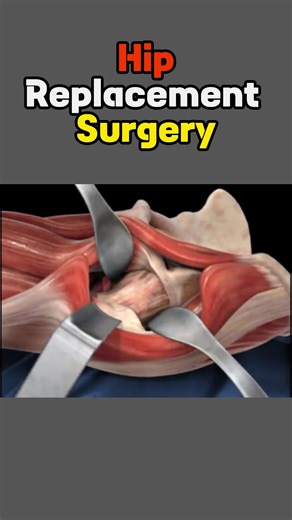 Hip Replacement #hip #replacement #procedure #femoral #artery #usetools #medical #surgery #3danimation #watch #foryou #foryourpage