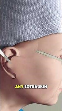 What is a MINI Face Lift Procedure?