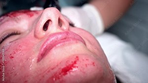 4K Close-up Woman Face Bleeding, Microneedling Procedure