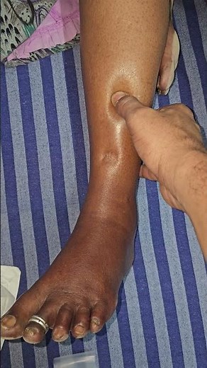 How to Examine Pedal Edema #legswelling #imwell