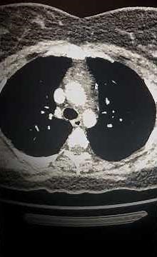 CT evaluation - looking at thymic hyperplasia