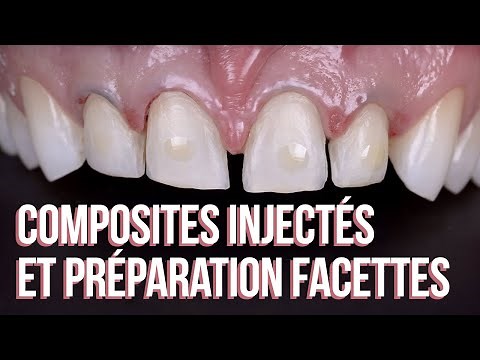 🤩 Cas clinique composites injectés et préparation de 4 facettes