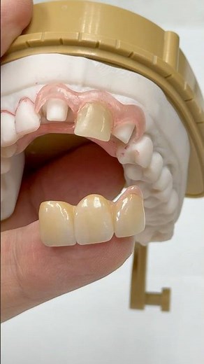 From a Nesbit to a Zirconia Bridge #lsk121shorts #dentist #teeth