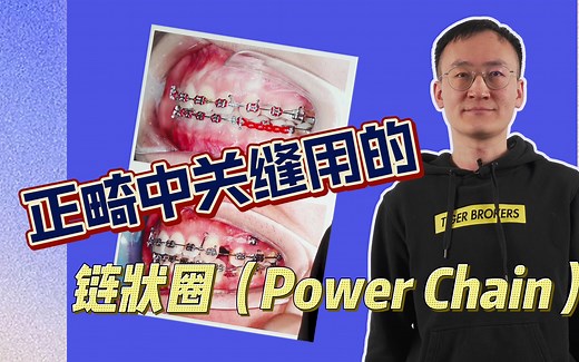 正畸中关缝用的链状圈（Power Chain）