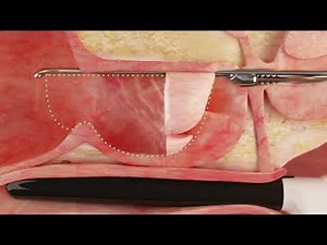 Aquablation Therapy - Step 2: Removing the Prostate Tissue