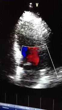 Ecocardiografia Doppler color.