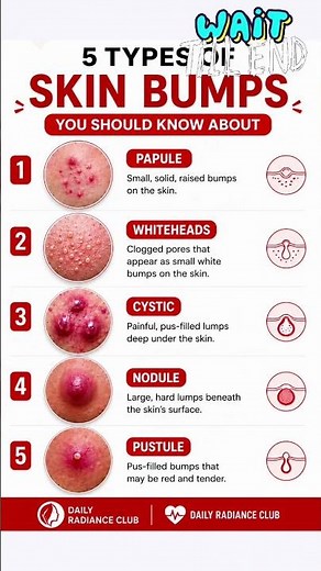 Which medicine works best for each type of acne? #AcneTreatment #AcneMedicine #SkinCare