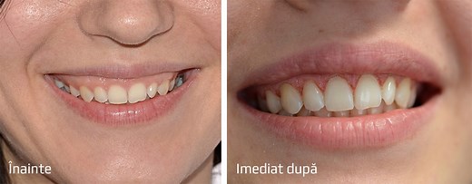 Gingivectomie - Tratamentul Gingiilor cu Laser | Gentle Dentist
