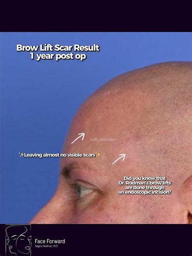Brow Lift| Scar Results| 1 Year Post Op| Facial Plastic Surgery