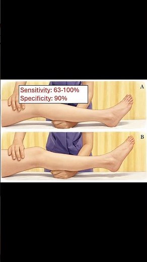 Lever Test (Lever Sign Test) 🦵🔍 ACL Rupture #meded #ortho #physio #ATC