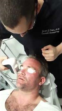 QuadroStar Pro Yellow Laser For Rosacea and Facial Redness / Clear + Brilliant in Men