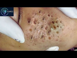 STOP Pain & Scarring: The ZERO SCAR Formula I&D Method for Severe Cystic Acne