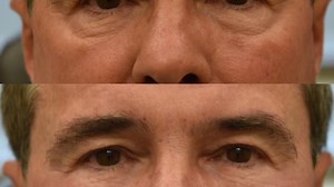 How to inject filler to improve under eye bags and dark circles