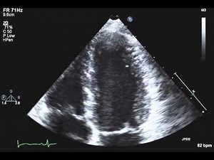 TTE Normal Apical 4 chamber LV zoom Example 1