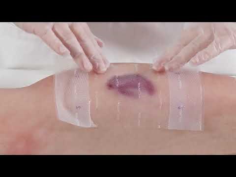 Mepitel One for Skin Tears - Application Guide