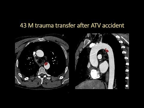 Aortic Trauma by Jody Shen, MD, Stanford Radiology