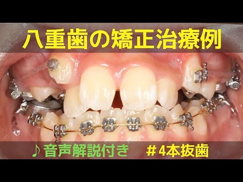 【矯正・八重歯】4本抜歯ワイヤー矯正治療例│ガチャ歯・凸凹・叢生│ fang/double tooth/crowding│音声解説付き