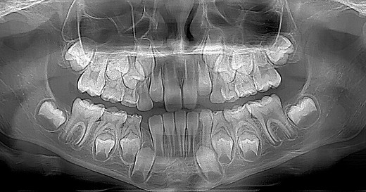 Hyperdontia: Treatment & Causes of Extra Teeth in the Mouth - Dentaly.org