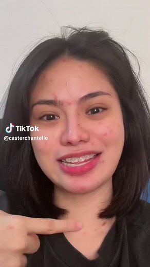 Understanding Chicken Pox: Symptoms, Treatment, and Prevention