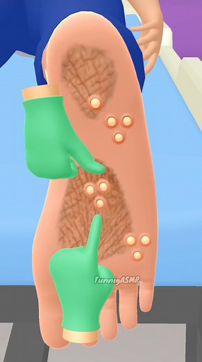 200K views · 424 reactions | Popping pimples one after the other Scratch Clean Foot cleanup Asmrvideo #footcare #shorts #cleaning #feetcare #shortsreels #reelstrending #acnetreatment #footcare #asmr #asmrvideo #scratch #clean Tunnig ASMR | Tunnig ASMR | Facebook