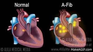 Atrial Fibrillation Anatomy, ECG and Stroke, Animation. on Make a GIF