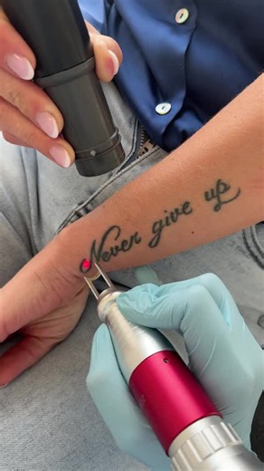 NEVER GIVE UP❤️ …but everything has a time #firstsession #tattooremoval #picoplus #picolaser #detatouage picosure laser tattoo