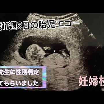 【妊娠3ヶ月】妊娠11週6日の妊婦検診 胎児エコー Ｒ先生性別判定【ベビーナブ】