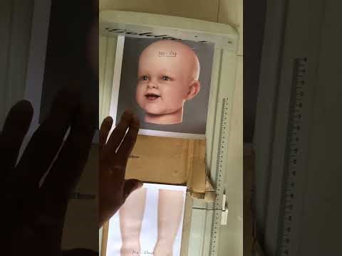 इन्फैंटोमीटर का उपयोग 📏 | शिशु की लंबाई नापने का सही तरीका जानें #growth monitoring #stunting