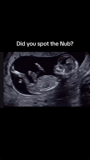 Decoding the Nub Theory: Understanding Boy or Girl?