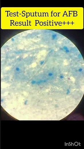 Sputum AFB test Slide Positive +++ Microscopic View TB Positive Test