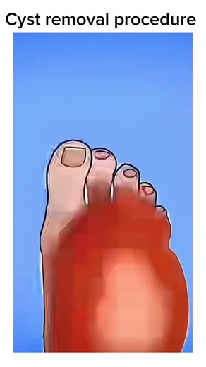 Surgical Animation on Instagram: "Follow @surgicalpovs for more! 🏥"