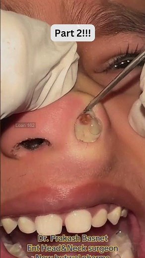 🔥Deep Blackheads, Milia & Whitehead Removal pimple popping New| Big Cystic Acne Extraction#1307 2026