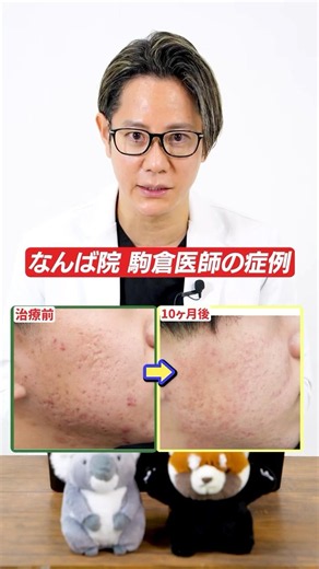 Case study: The Hanafusa Method for acne scar treatment at Hanafusa Dermatology Namba Clinic✨#shorts
