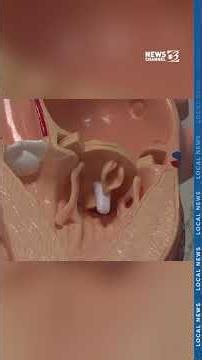 87-year-old receives West Michigan's first minimally invasive valve repair