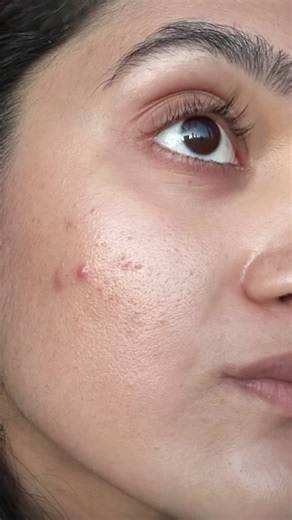 Blue Serum is here to help you achieve clearer, smoother skin with every use! 🩵 #herbivorebotanicals #bluewaveserum #skincare #acne