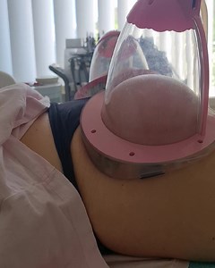 Vacuum BBL-$50 | Face and Body Therapy Perth Australia | Facebook