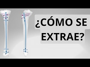 CLAVO DE TIBIA ¿COMO SE SACA?