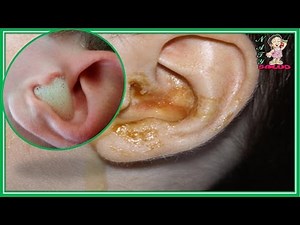 🌺🌻🍀 ¡6 formas de remover completamente la cera de los oídos!