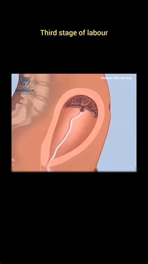 Medteach | Bsc nursing | 👶 Removal of placenta explained Final stage of labour Uterus contracts naturally Prevents heavy bleeding Helpful for students & parents 💡... | Instagram