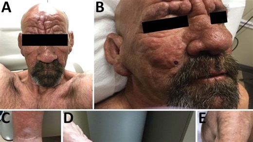 Did the CDC issue a Florida travel advisory due to rising leprosy cases?